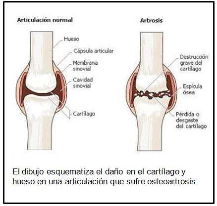 tratamiento de la osteoartrosis
