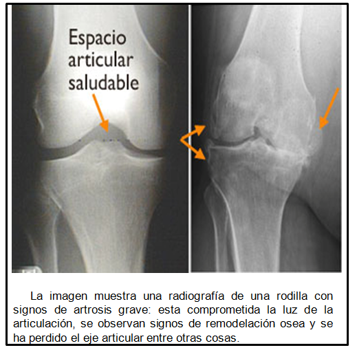 tratamiento de la osteoartrosis