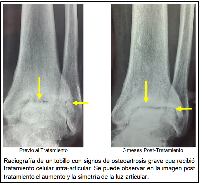 tratamiento de la osteoartrosis